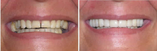 full mouth Ceram after